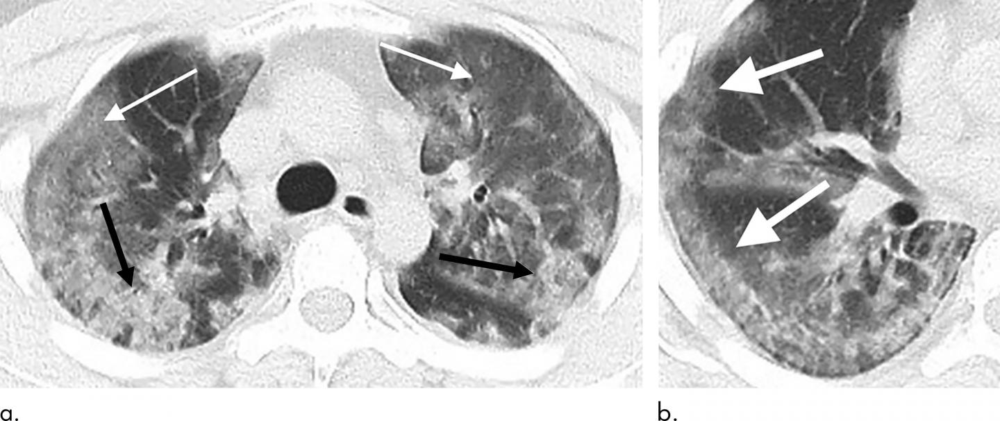 Radiologists Describe Coronavirus Imaging Features