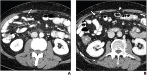 Positive oral CT contrast improves detection of malignant deposits in intraabdominal nonsolid organs - EurekAlert