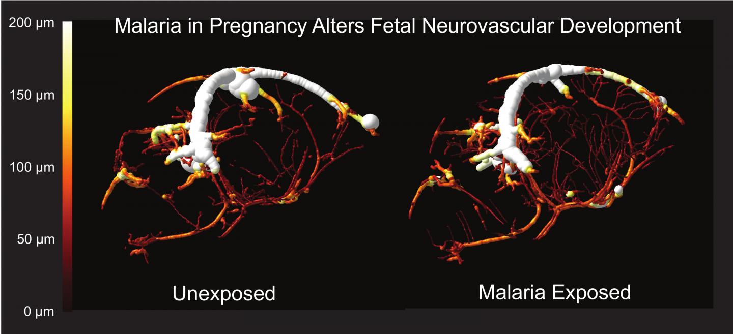 Maternal Malaria Infection Alters the Formation of Blood Vessels in the Brains of Exposed Offspring