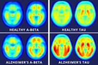 Brain Imaging Links Alzheimer's Decline to Tau Protein
