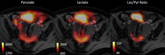 Different rates of pyruvate conversion into lactate in different tumour deposits