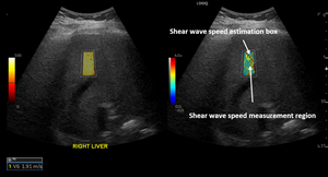 COVID-19 Patients Show Liver Injury Months After Infection