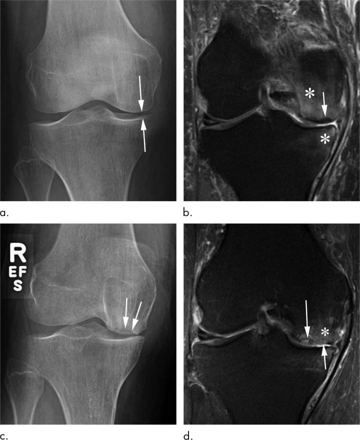 Steroid Injections of Hip and [IMAGE] EurekAlert! Science News Releases