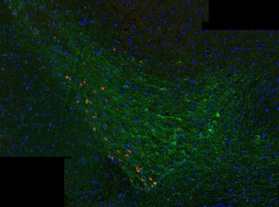 Parkinson's Disease Protein Causes Disease Spread and Neuron Death