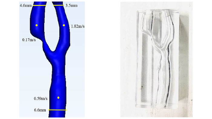 3D reconstruction of a carotid artery stenosis vessel