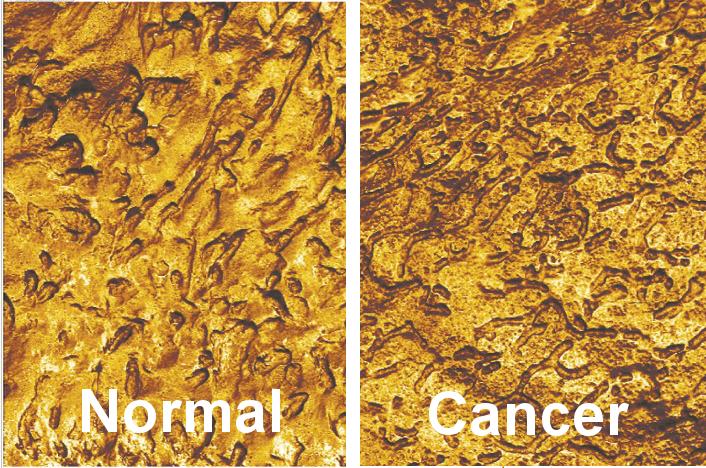 AFM Map of Normal Versus Cancer Cell Surface