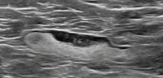 55-year-old woman who underwent screening mammogram and ultrasound 7 days after first COVID-19 vaccination dose