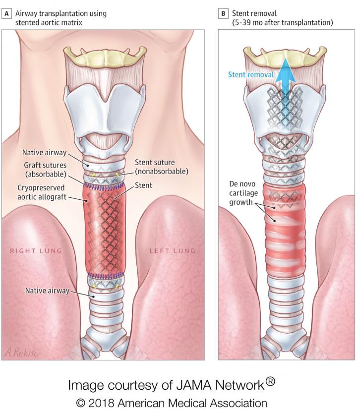 Illustration of Airway Reconstruction Method