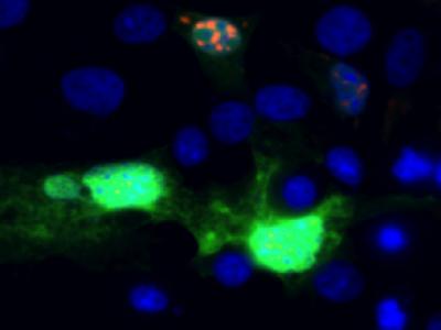 Tremor Ataxia Syndrome Cells