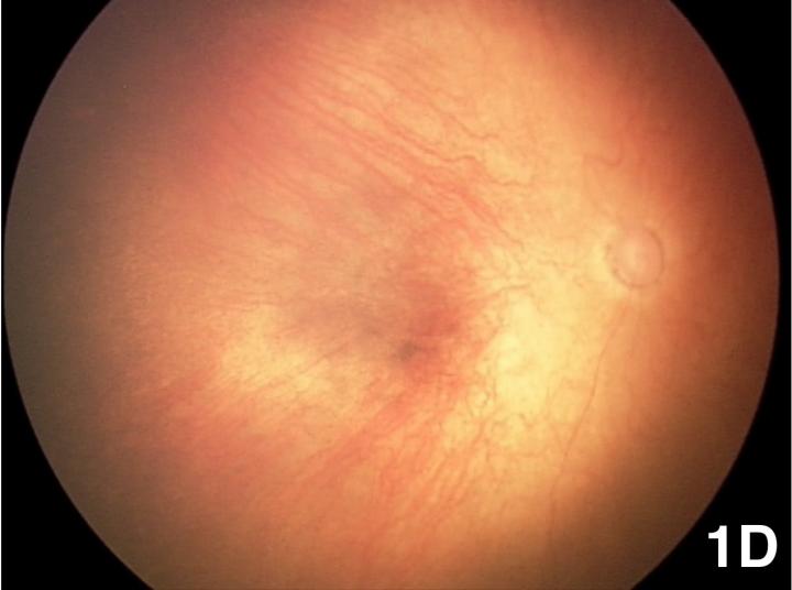 Image of Eye in Baby with Zika-Induced Microcephaly Showing Retinal Blood Vessel Termination