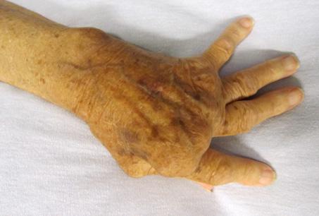 Rheumatoid Arthritis