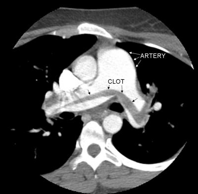 Pulmonary Embolism Imagery