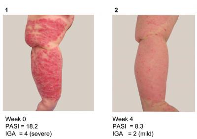 Lone Antibody Tackles Scaly Skin, Inflamed Eyes and Arthritis (1 of 2)