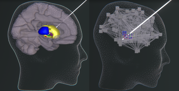 First clinical use case of multiscale co-simulation of the human brain applied for in silico optimization of deep brain stimulation in Parkinson’s disease.