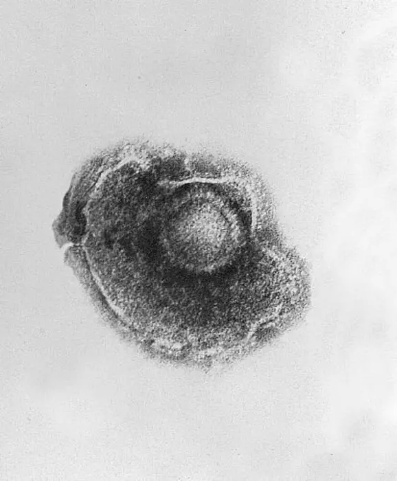 Electron micrograph of varicella virus