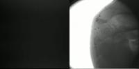 X-Ray Video of Double Kneecap