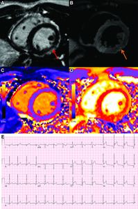 MRI Sheds Light on COVID Vaccine-Associated Heart Muscle Injury