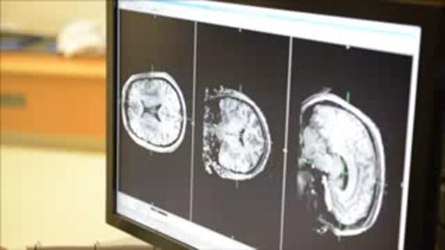 New Imaging Research Shows Increased Iron in the Brain in Earliest Stages of MS