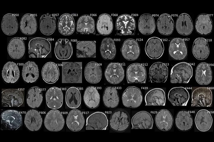 Cerebral palsy also has genetic underpinnings