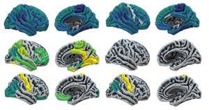 Relation of glucose metabolism in the brain and levels of consciousness