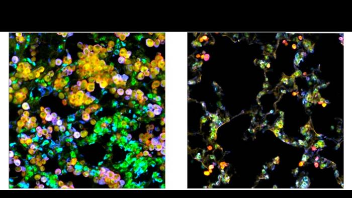 Adenocarcinoma cells