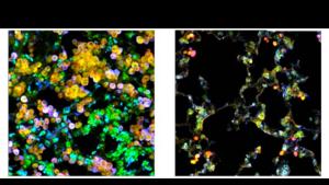 Adenocarcinoma cells