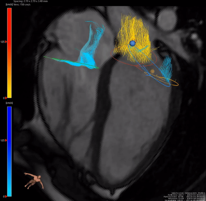 The image shows streamlines of blood flow in three-dimension over time (the fourth dimension) through the heart's four valves.