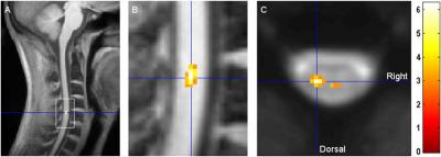 Pain Relief through Distraction -- It's Not All in Your Head