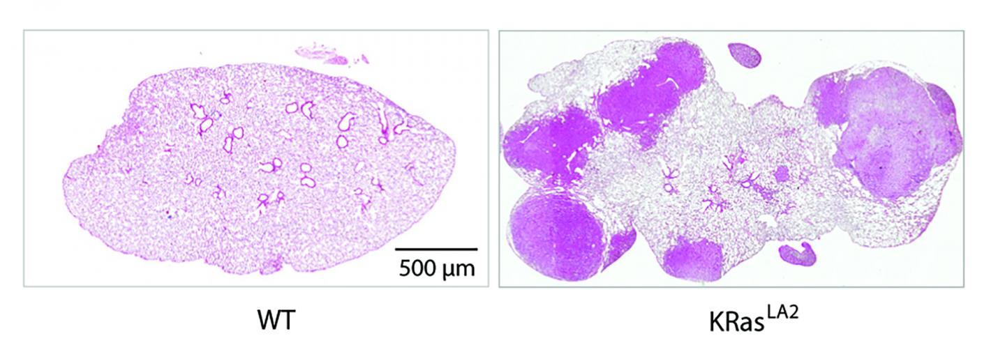 A Sigh of Relief: Insights into Why Lung Cancer Causes Breathing Difficulties (5 of 8)