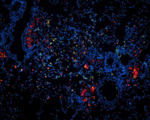 Tuberculosis Therapy: Smallest Particles Will Deliver the Drug to the Lungs in Future