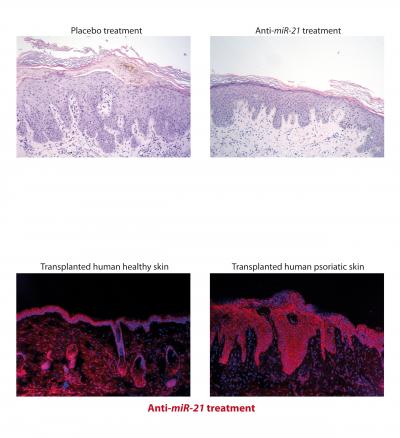 Small RNAs Tackle Skin Rash (2 of 2) | EurekAlert!