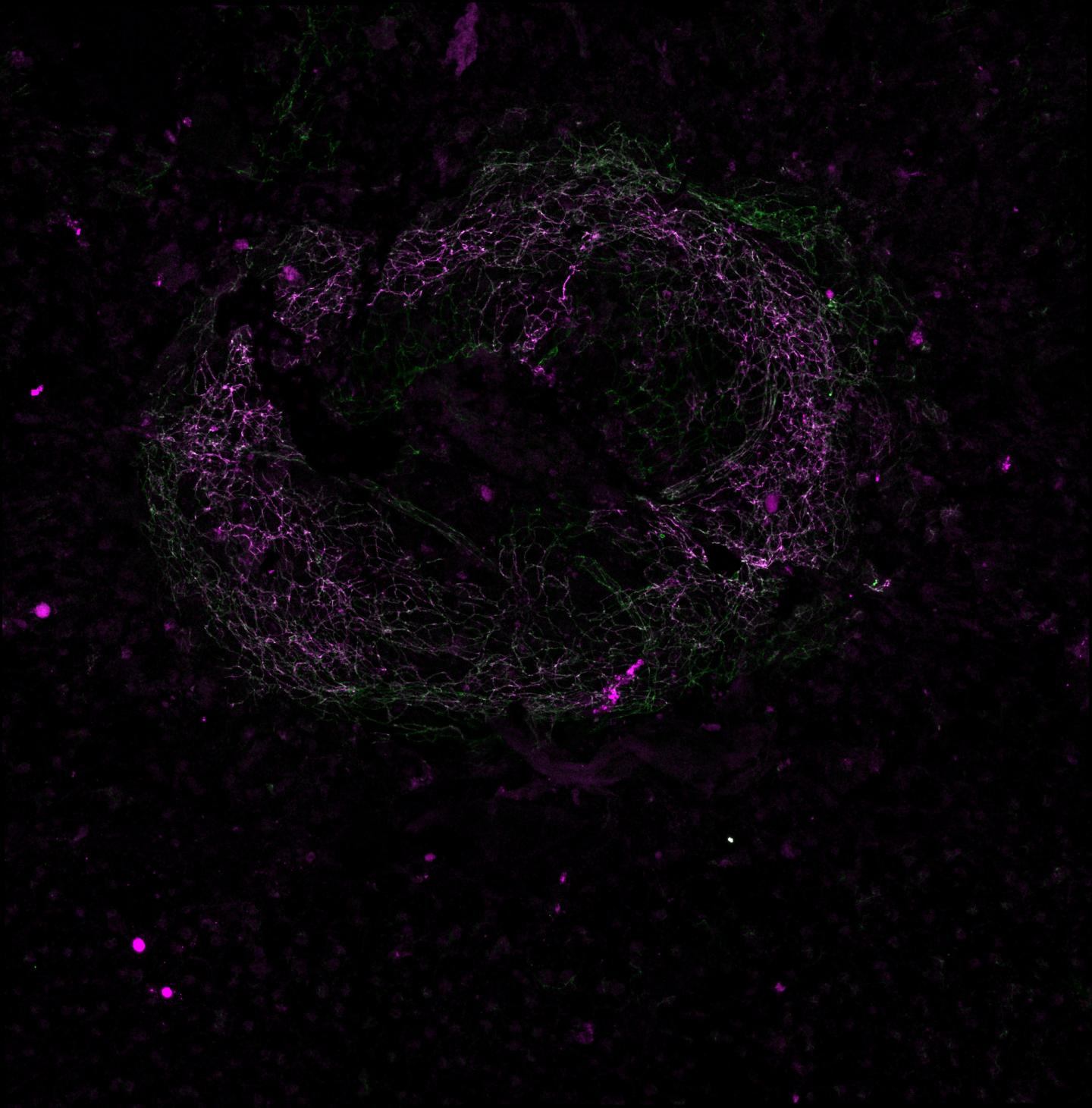 Vascular Lesion