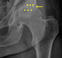 Hip Steroid Injections Associated with Bone Changes (2 of 2)