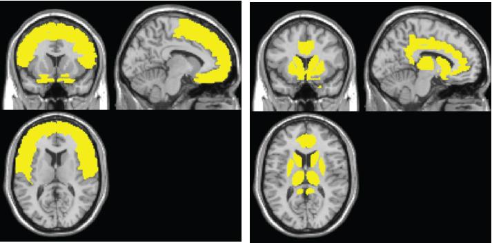 Brain Map Tracks Early Brain Atrophy from HIV Infection