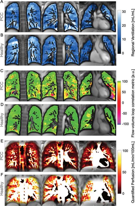 Images show exemplary coronal sections of phase-resolved functional lung MRI ventilation and perfusion maps in a 15-year-old with post–COVID-19 condition and in a healthy control participant.