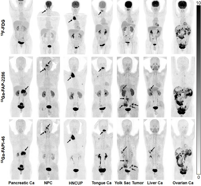 Maximum-intensity projection images of 18F-fluorodeoxyglucose (FDG), 68Ga-FAP-2286, and 68Ga-FAPI-46 PET/CT imaging in seven patients with different types of cancer.