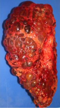 Polycystic Kidney Disease 1