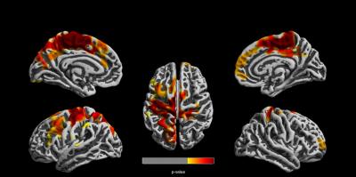 Brain Images Showing Affect of Air Pollution on 12 Year Olds