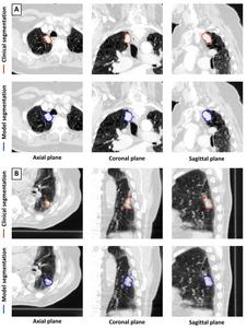 Deep learning model shows promise in detecting and segmenting lung tumors