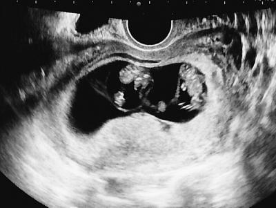 An Ultrasound Image Showing Zygotic Splitting in Process in the Womb