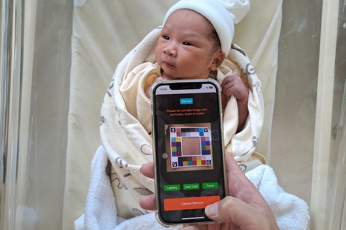 BiliSG being used on an infant to monitor their bilirubin levels