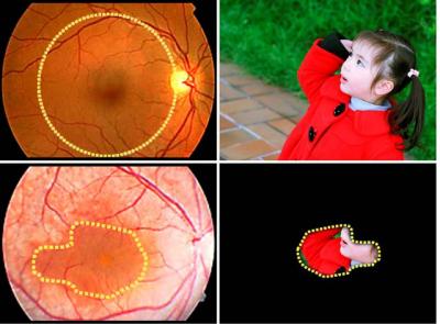 Vision of Patients with Retinitis Pigmentosa (1 of 2)