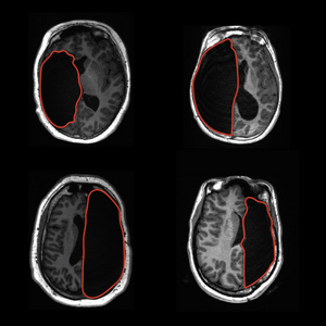 Examples of a single hemisphere in four children after surgery to manage drug-resistant epilepsy
