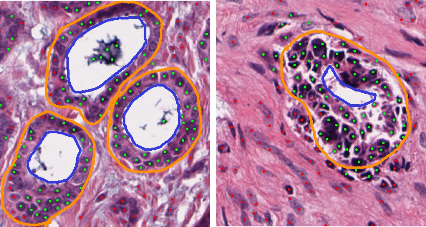 Computerized Tissue Image Analysis Helps Discern Aggressive ER+ Breast Cancers