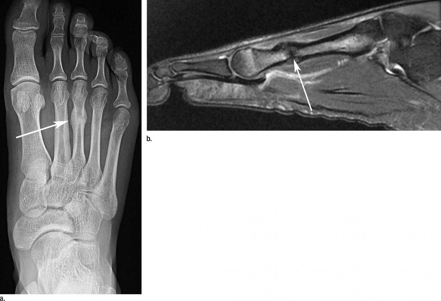 Images in a Long-Distance Runner with Left Foot Pain without a Triggering Acute Traumatic Event