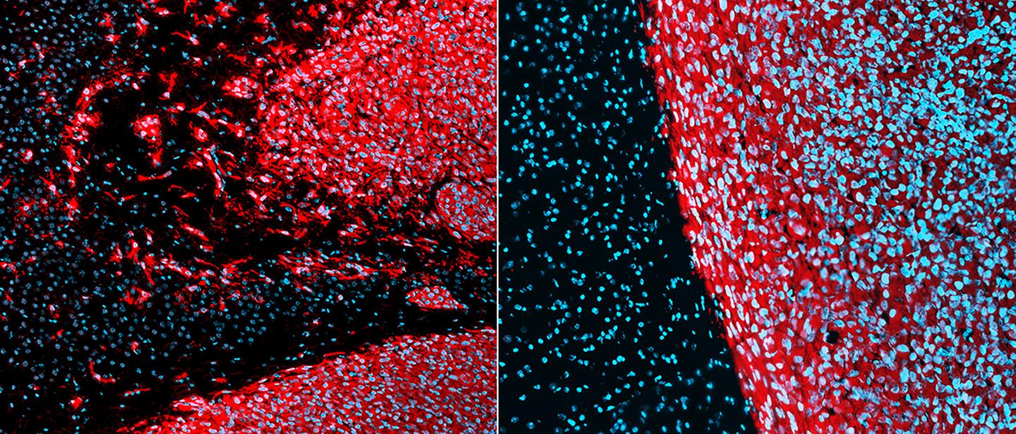 Patient-Derived Glioblastoma in Murine Brain