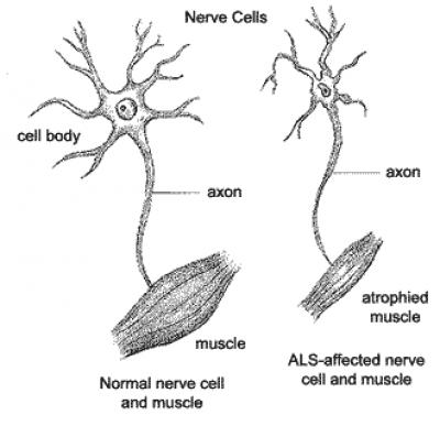 Nerves and Muscles Affected by ALS