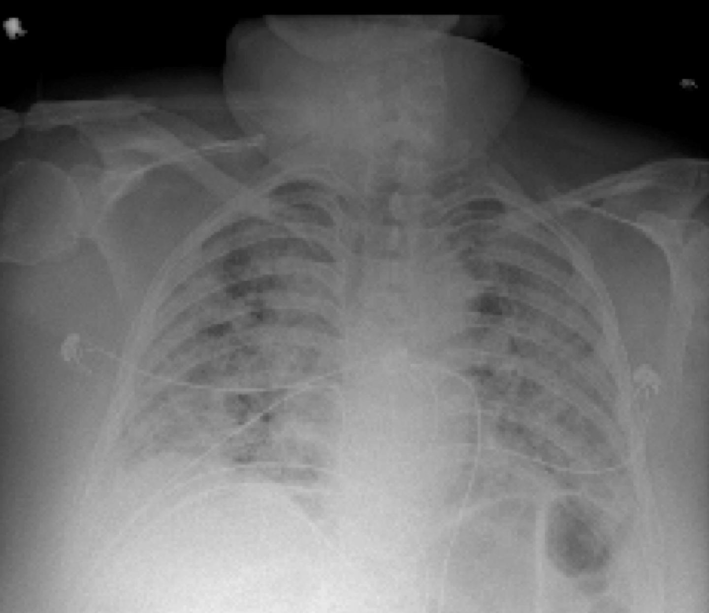 Chest X-Ray of Covid-19 patient