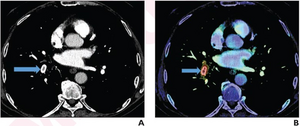 54-year-old with mild chest pain for 3 days who underwent CTPA to assess acute PE