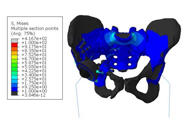 'Endoprosthesis-skeleton' Model